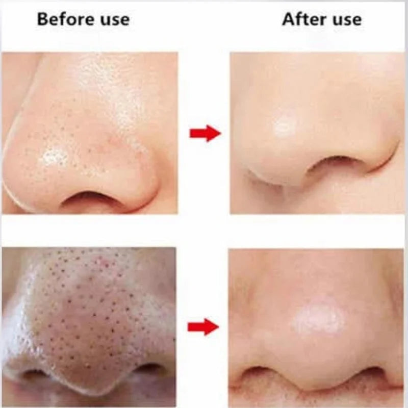 Rechargeable Blackhead Remover Vacuum Cleaner | Model FPLS-001